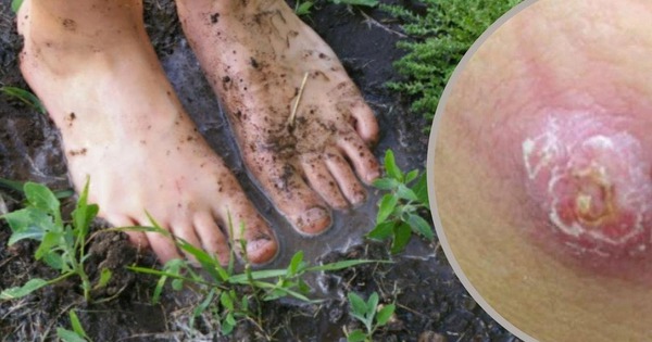 Hiểu đúng về bệnh do "vi khuẩn ăn thịt người"