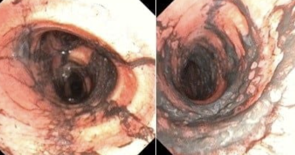 Ngạt khói nặng sau vụ cháy, đôi vợ chồng trẻ được hồi phục kỳ diệu