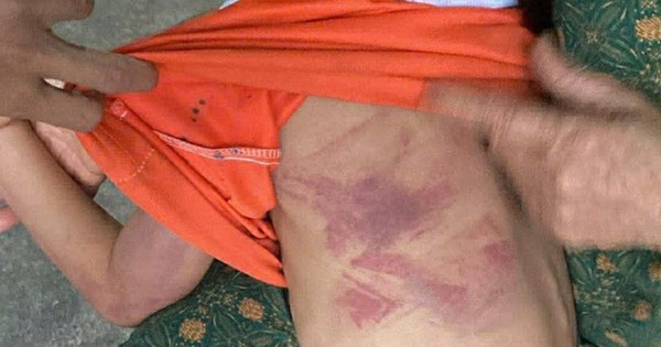 Bé gái lớp 2 bị bạn cùng lớp dùng thước đánh thâm tím người vì không cho kẹo