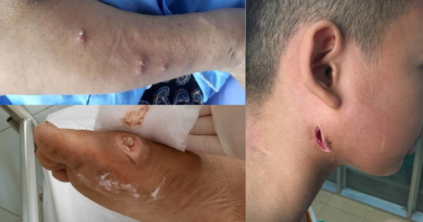 Bộ Y tế nói gì về bệnh "sốt đất" (Whitmore) sau 23 ca tử vong ở Thái Lan?