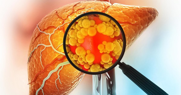 Đảo ngược gan nhiễm mỡ không cần ăn kiêng: Đột phá từ Mỹ