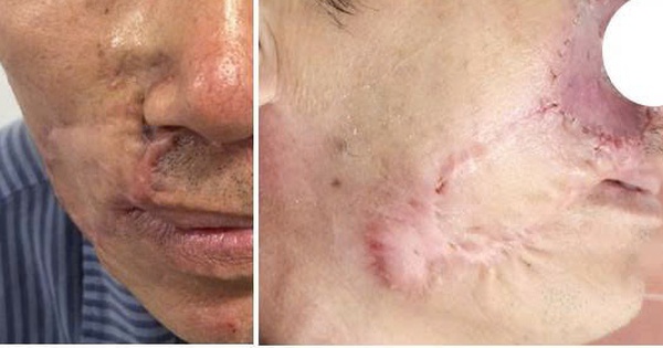 Ung thư da tái phát sau nhiều lần mổ, lan ngầm dưới da