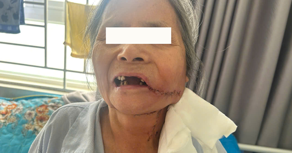 Phát hiện ung thư từ một vết loét ở miệng