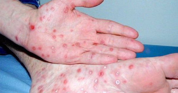 Thông tin nổi bật tại TPHCM ngày 4-5: Người mắc bệnh giang mai tăng; mở rộng đường Trần Bình Trọng