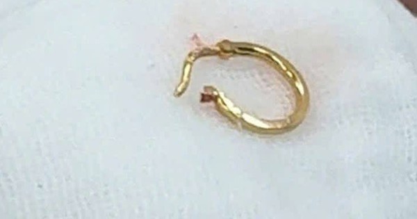 Bé gái nhập viện vì chiếc bông tai trong thực quản