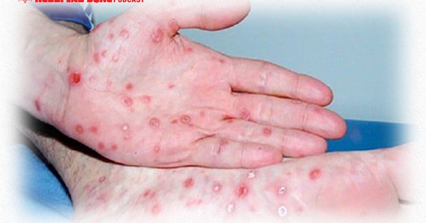 Cảnh báo ca bệnh giang mai tăng nhanh