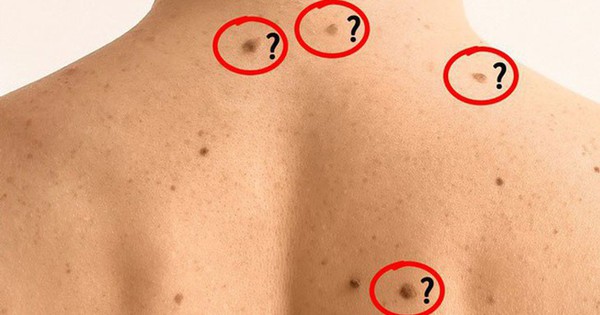 Nổi nhiều nốt ruồi là dấu hiệu ung thư?