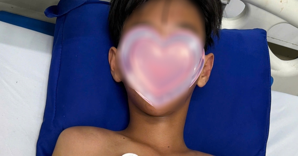 Bé trai ở Cà Mau bị ong vò vẽ đốt hơn 50 vết