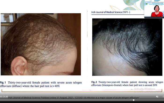 Tin vui dành cho người bị rụng tóc Đã tìm ra giải pháp mới trong hỗ trợ  giảm rụng tóc và kích thích mọc tóc  VTVVN