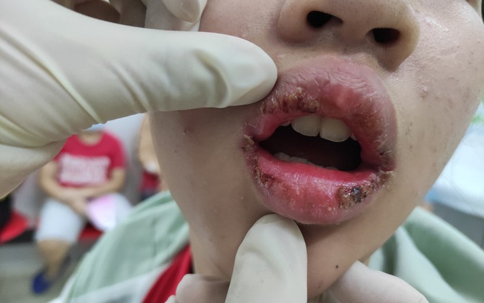 Thiếu nữ 15 tuổi lở loét môi sau khi bôi son - Báo Người lao động