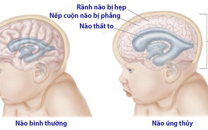 Bị não úng thủy nên chữa lúc nào là tốt nhất? - Báo Người lao động