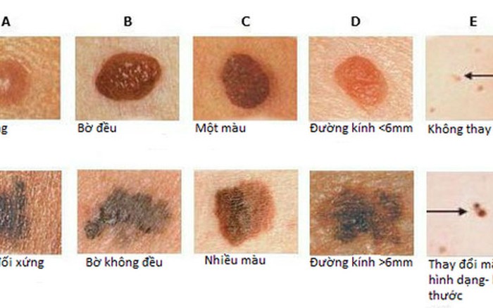 Minh họa nốt ruồi và thay đổi sắc tố da theo thời gian
